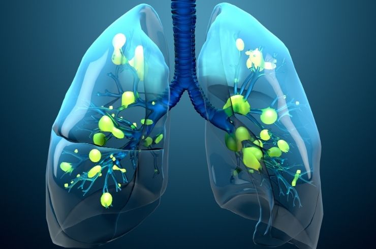 Pneumonia image