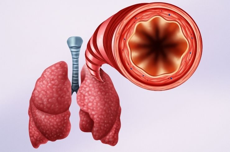 Bronchitis image