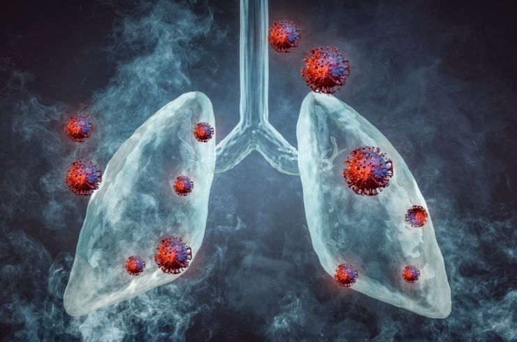 COPD image